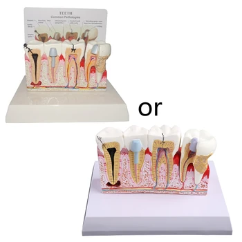 Модель развития кариеса зубов G5AA, обучение врачу-пациенту и уходу за полостью рта для педагогической практики, модели преподавателей и студентов